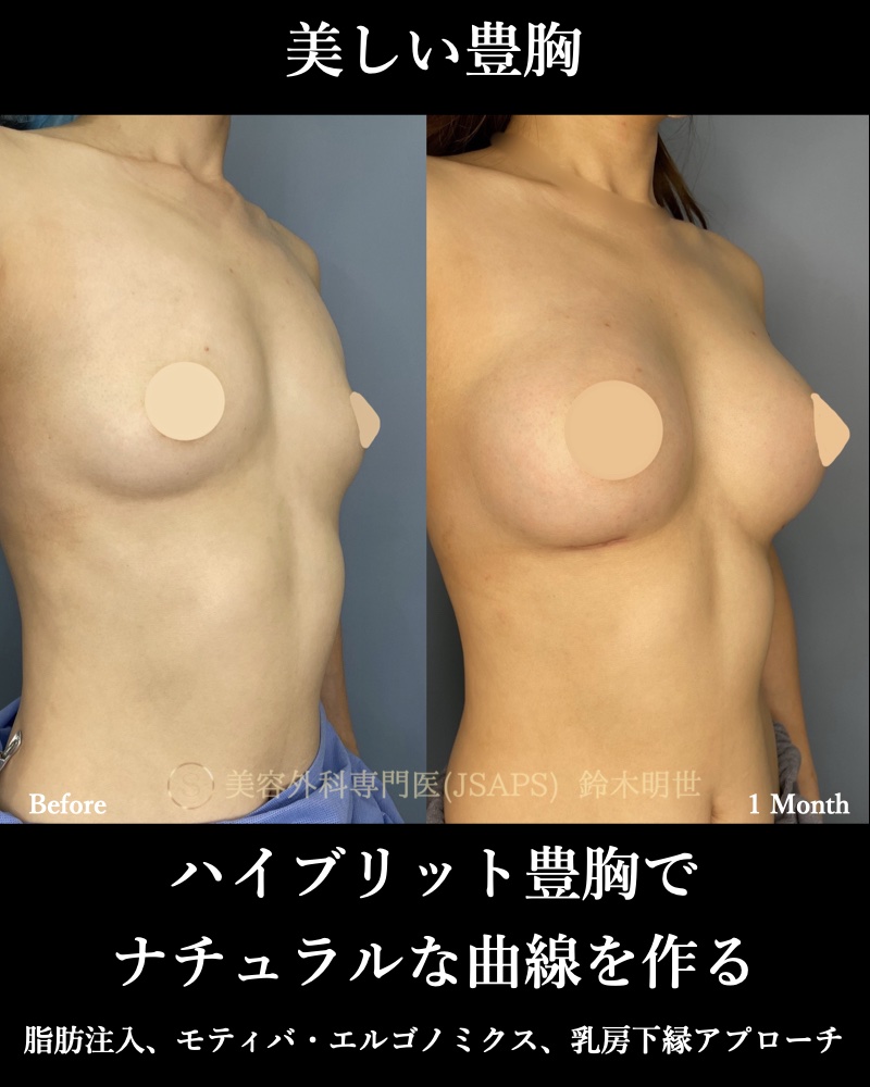 breast augmentation
hybrid (implant plus fat injection)