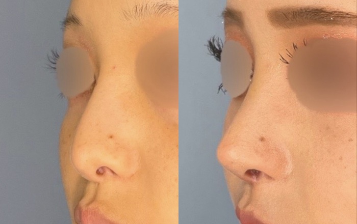 Nose Revision [Revision surgery of another clinic's outcomes
